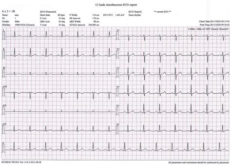 ecg chanel|What are the differences between 1, 3, 6, and 12 .